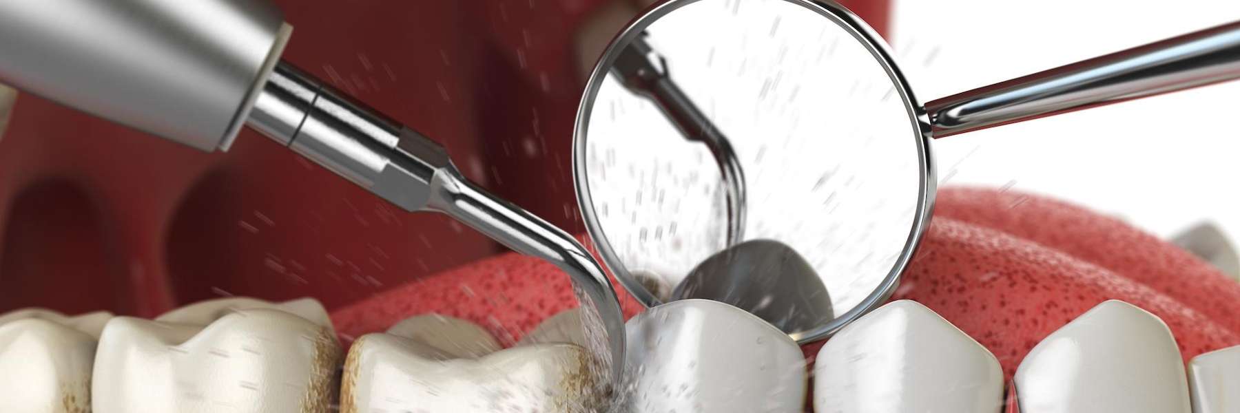 An illustration of a dental cleaning 