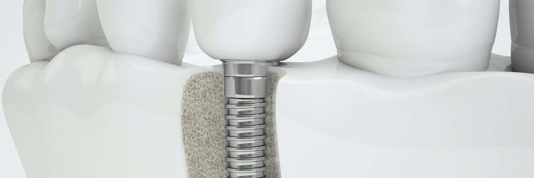 dental implant diagram | Norfolk dentist