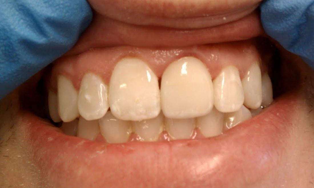 Close up of results from procedure for porcelain veneers in Norfolk MA