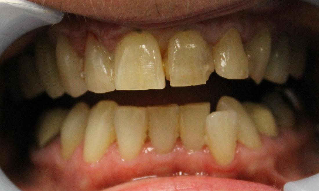 Patient with misaligners and severely discolored teeth at Norfolk County Dental Care
