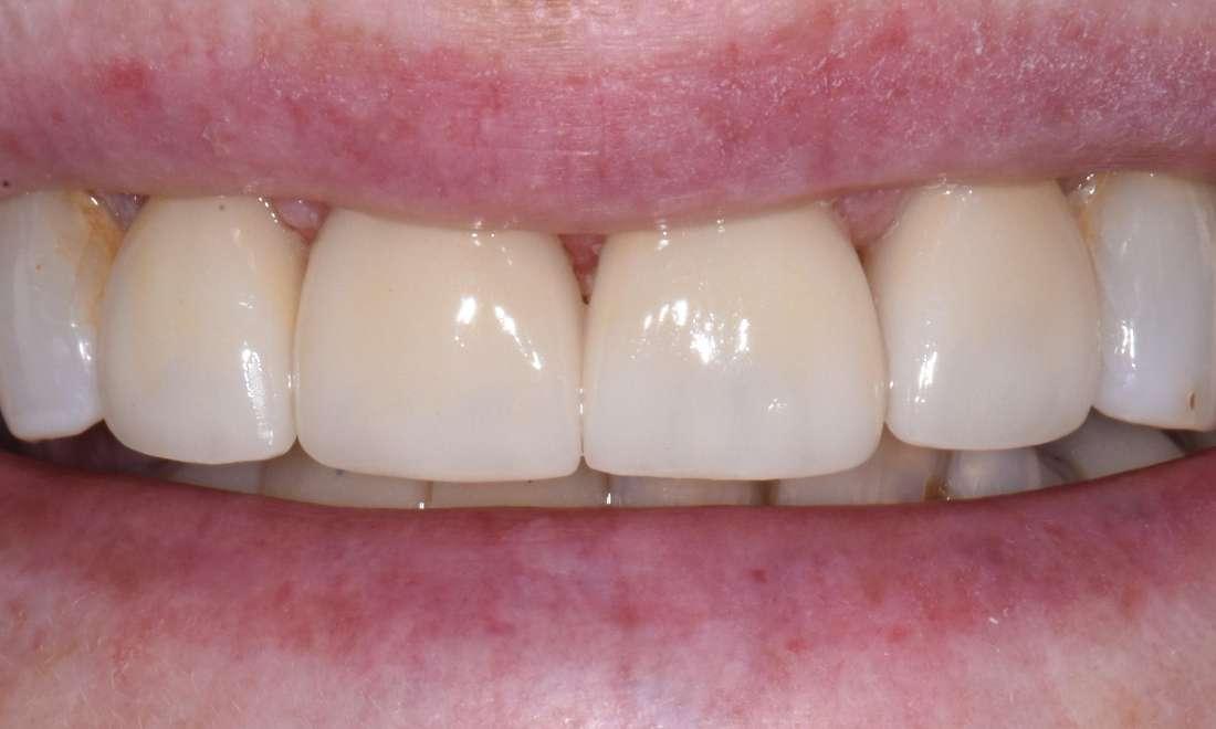 porcelain veneers to improve worn down front teeth