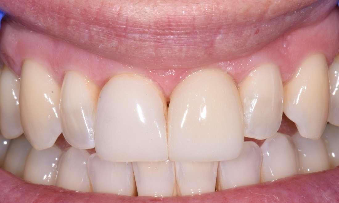 After Veneer