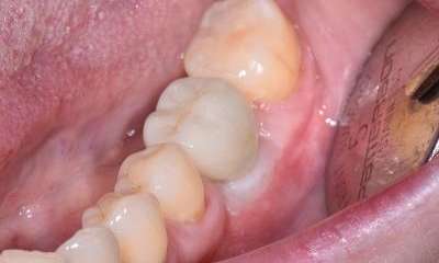 dental implant post with new porcelain crown