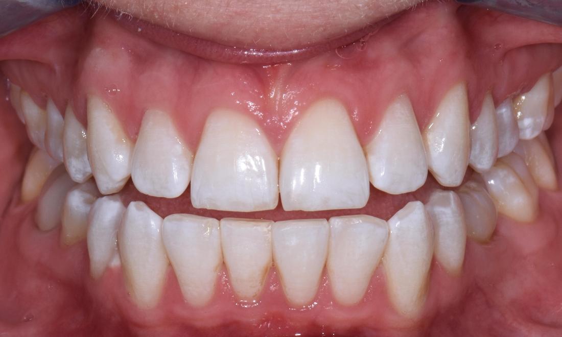 Patient after Zoom In Office Bleaching