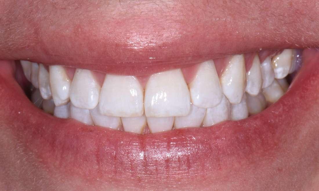 Patient after Zoom In Office Bleaching