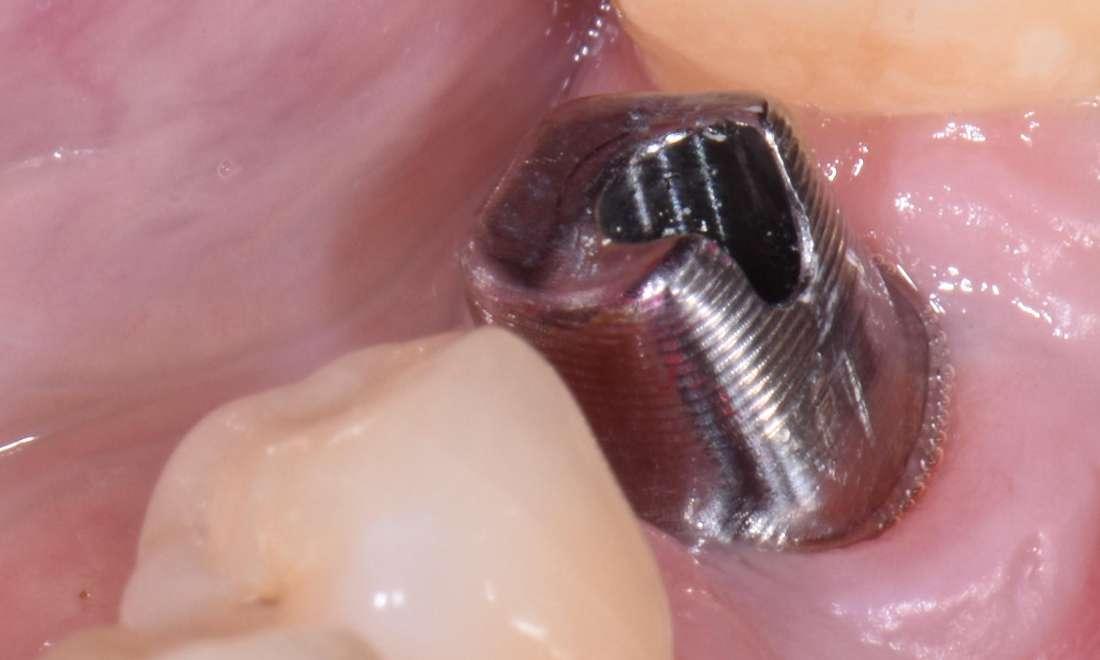 dental implant post before dental crown in Norfolk MA
