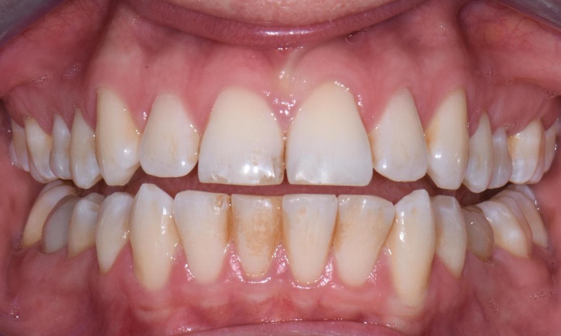 Patient before Zoom In Office Bleaching