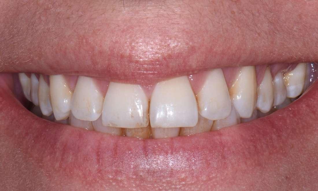 Patient before Zoom In Office Bleaching