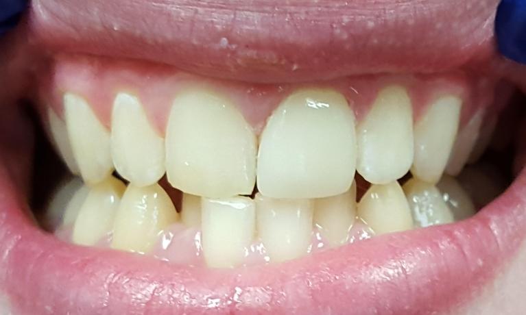 CEREC-Crown-After-Image