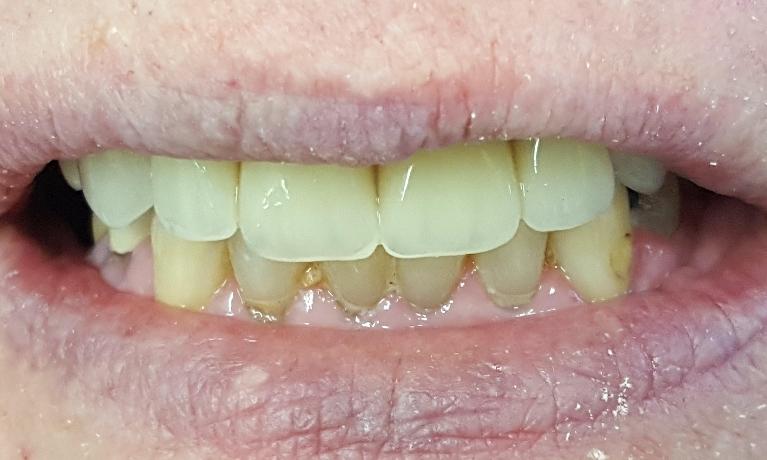 Before-and-After-Dentures-After-Image