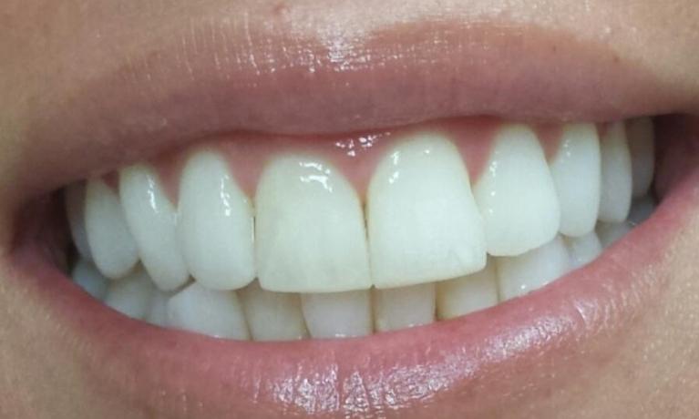 Close up of patients smile after treatment with Invisalign in Norfolk MA