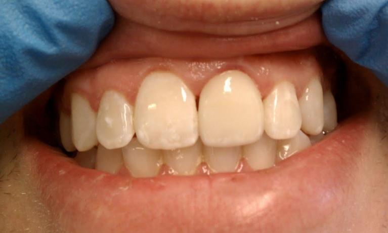 Porcelain-Crowns-After-Image