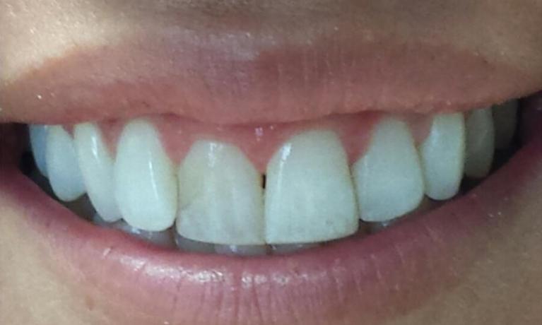 Patient with misaligned teeth at Norfolk County Dental Care