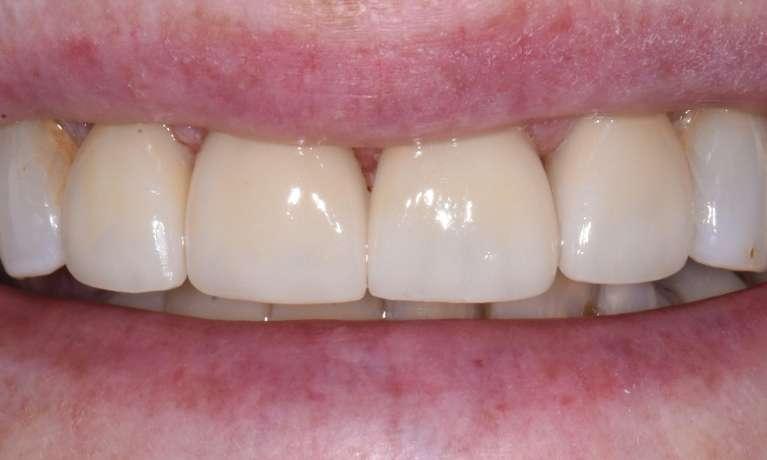 porcelain veneers to improve worn down front teeth