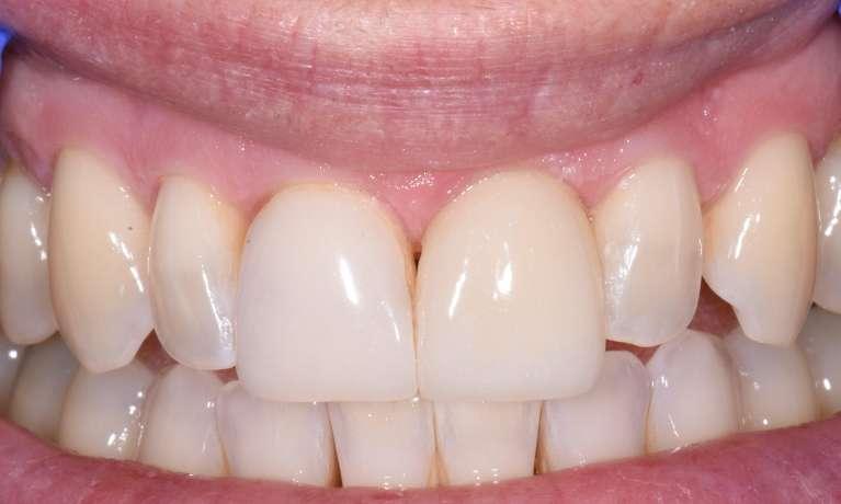 Veneers-After-Image
