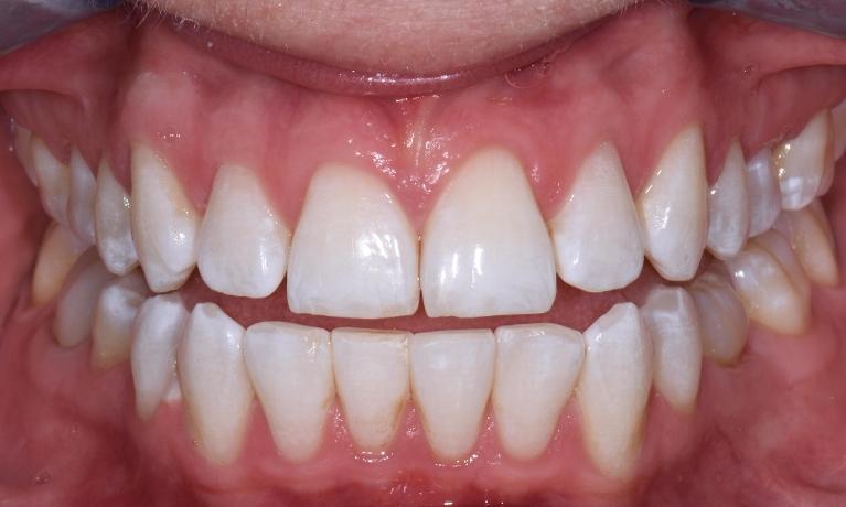 Before-and-After-Teeth-Whitening-After-Image