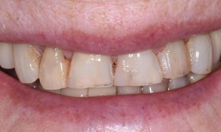 worn down front teeth