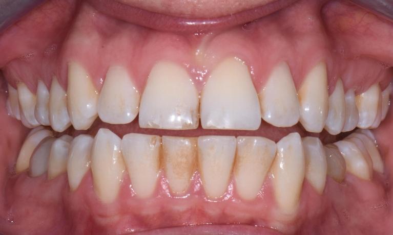 Before-and-After-Teeth-Whitening-Before-Image
