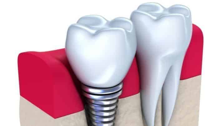 Digital image of dental implant replacing missing tooth in Norfolk