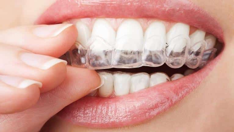 Close up of dental patient putting on Invisalign in Norfolk MA