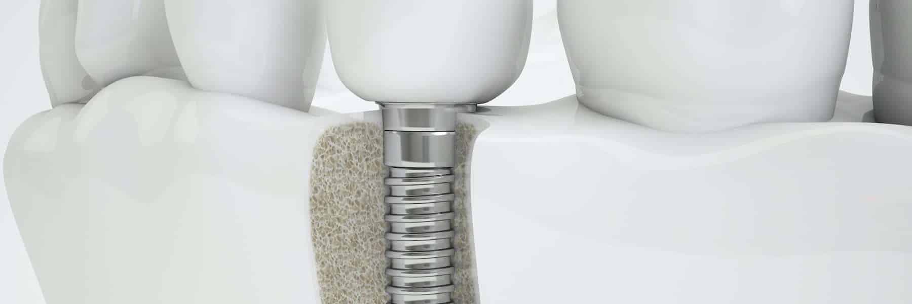 dental implant diagram | Norfolk dentist
