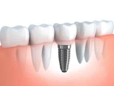 Graphic of dental implant screw in gums at 02056 dentist office