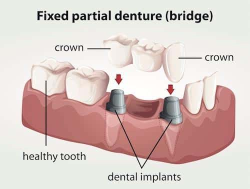 Diagram of a dental bridge in Norfolk MA