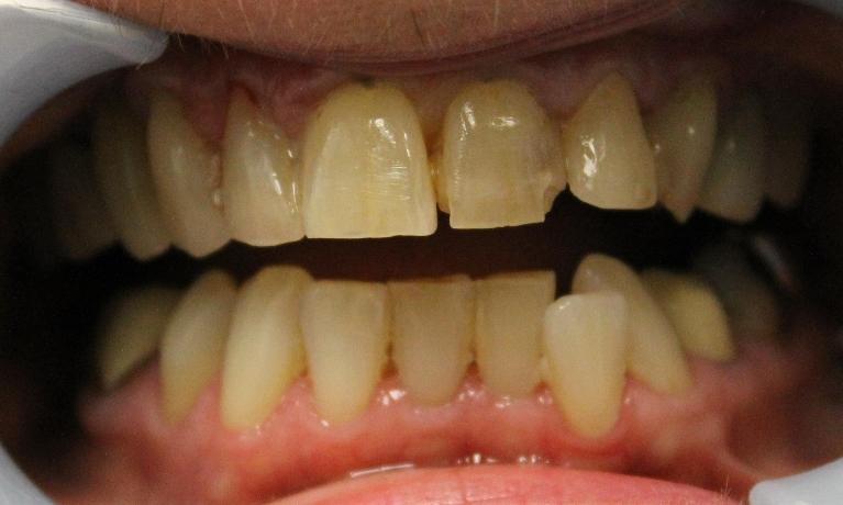 1781711720_medium_Before-Porcelain-Veneers-1