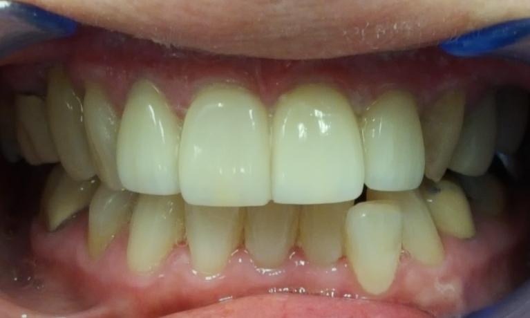 1781711765_medium_After-Porcelain-Veneers-1