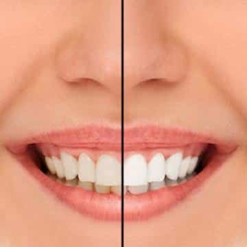 Before and after results of teeth whitening in Norfolk MA