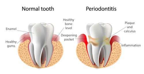 Diagram of healthy tooth and tooth with gum disease