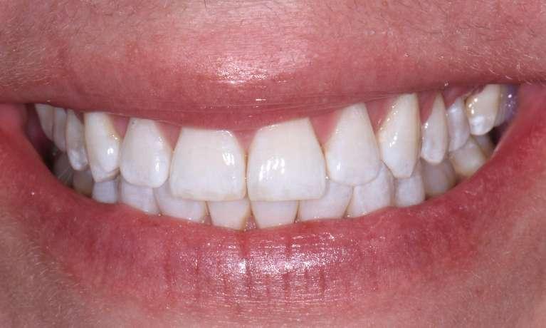 After Image: Teeth Whitening - front