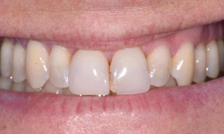 Before Image: Veneers - front