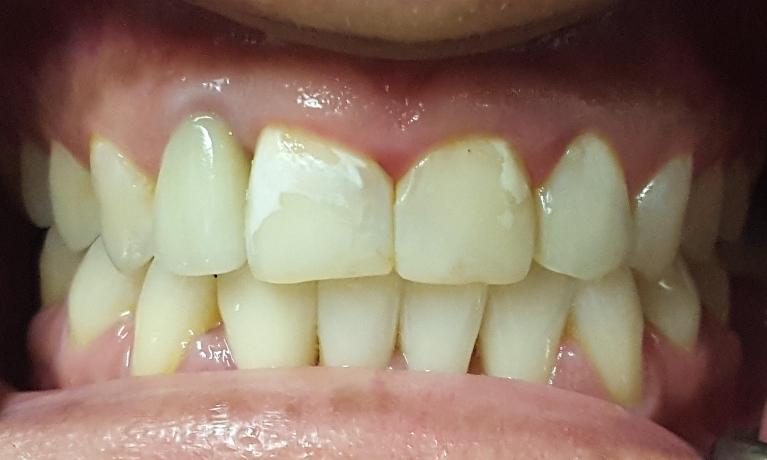 Before Image: CEREC Same-Day Restorations - front