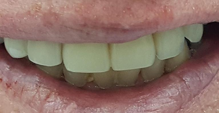 Before Image: General Dentistry - front