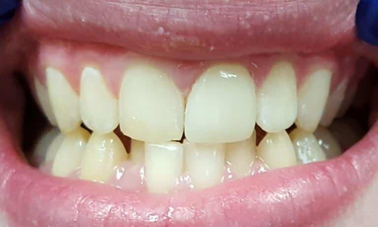 After Image: CEREC Same-Day Restorations - front