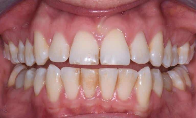 Before Image: Teeth Whitening - front