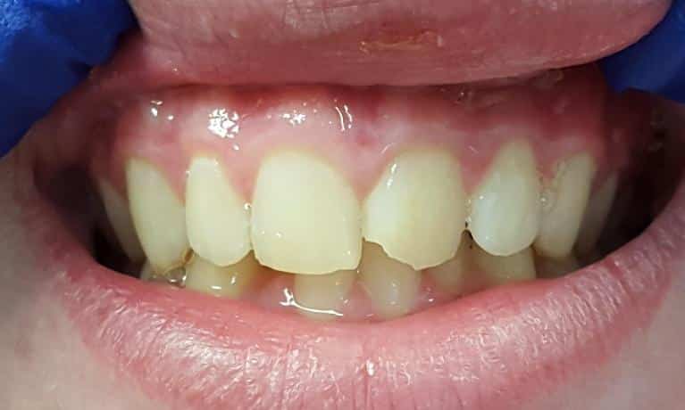Before Image: Cosmetic Dentistry - front