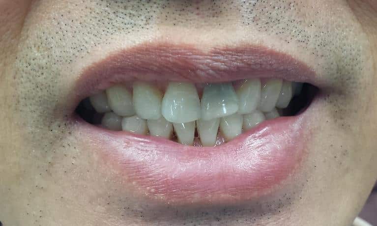 Before Image: Cosmetic Dentistry - front