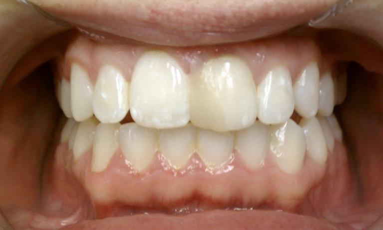 Before Image: Cosmetic Dentistry - front