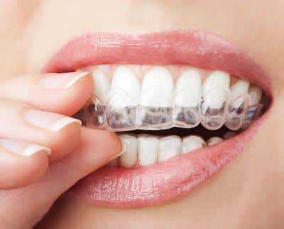 InvisibleBraces1